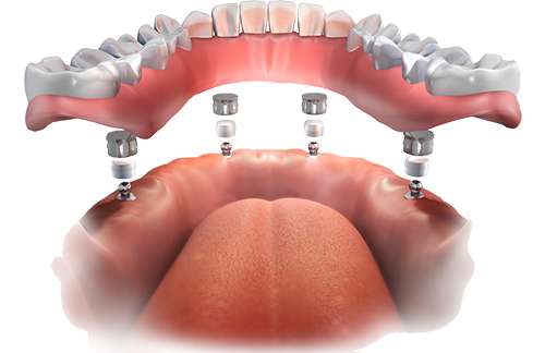 Implant Overdentures Parma Heights